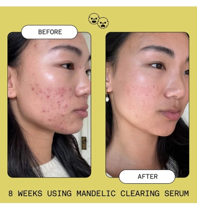 *SOBRE PEDIDO* Mandelic Acid Exfoliating & Clearing Serum