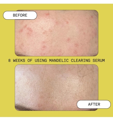 *SOBRE PEDIDO* Mandelic Acid Exfoliating & Clearing Serum