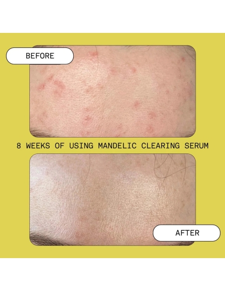 *SOBRE PEDIDO* Mandelic Acid Exfoliating & Clearing Serum