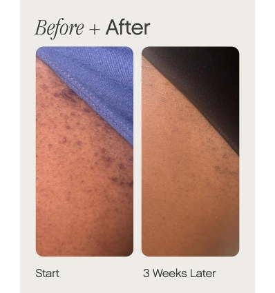 *SOBRE PEDIDO* High Roller Ingrown Hair Tonic