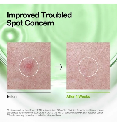 Anua - Azelaic 3 Cica Skin Clarifying Toner